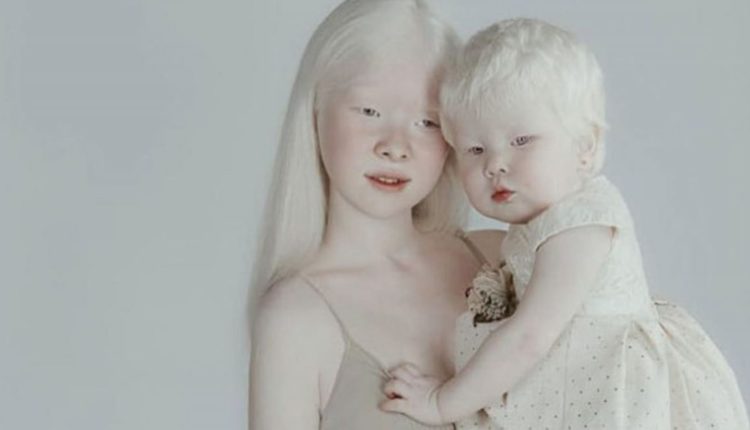 ensaio-deslumbrante-de-irmas-albinas-mostra-que-a-beleza-existe-nas-mais-diversas-formas